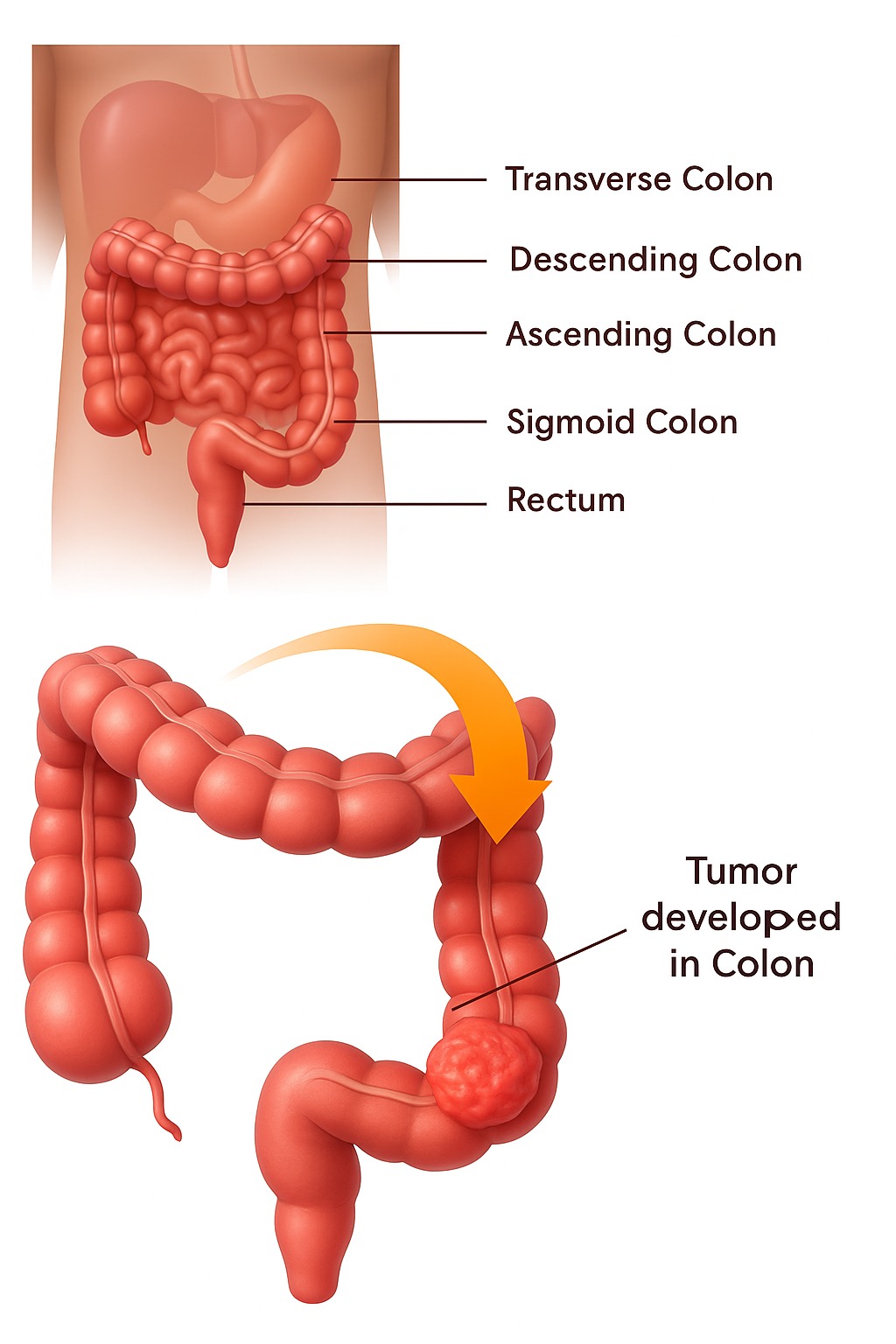 Colorectal Cancer